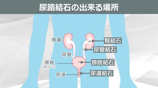 バットで殴られたような痛みが何度も　暑い夏は痛みの王様「尿路結石」のハイシーズン　自分で出来る予防法