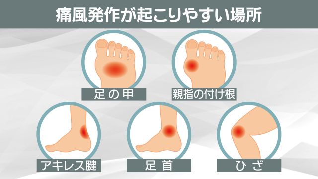 痛風発作は冬場も注意　イベントが多い季節　飲酒後にした方がいいこと