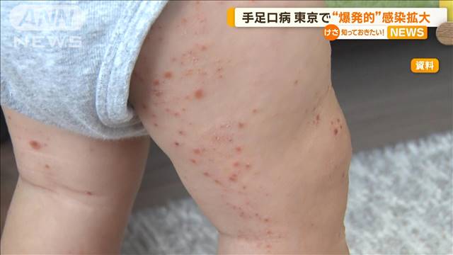 手足口病の感染者数　過去10年で最多　東京で“爆発的”感染拡大