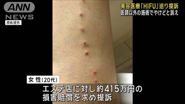 美容医療「HIFU」でやけど　医師以外の施術でエステ店を提訴