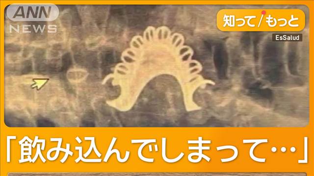 「入れ歯」のどに詰まり呼吸困難で緊急手術　ペルー